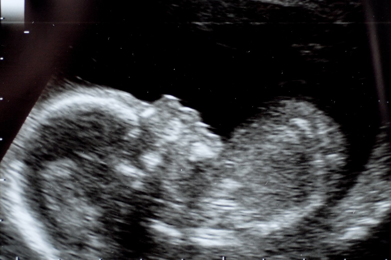 A 2D ultrasound image of a 16-week-old fetus, showing the developing head and body.