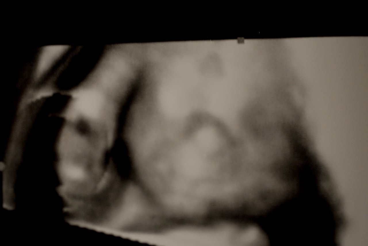 A 3D ultrasound image of a 16-week-old fetus.